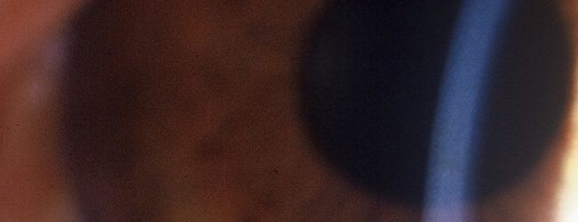 ΔΩΡΕΑΝ ΟΦΘΑΛΜΟΛΟΓΙΚΟΣ ΕΛΕΓΧΟΣ ΓΙΑ ΚΕΡΑΤΟΚΩΝΟ ΣΤΗΝ ΑΛΕΞΑΝΔΡΟΥΠΟΛΗ